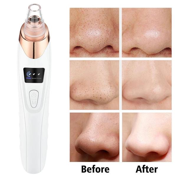 Advanced USB Rechargeable Blackhead & Pore Vacuum Cleaner – De Sleutel Tot Schone, Stralende Huid ✨💖