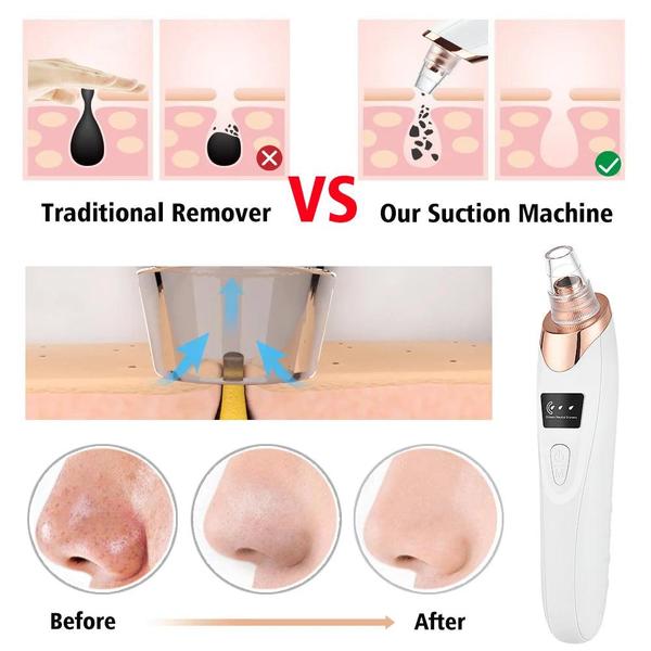 Advanced USB Rechargeable Blackhead & Pore Vacuum Cleaner – De Sleutel Tot Schone, Stralende Huid ✨💖